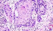 Un dispositivo portátil diagnostica cáncer oral con láser