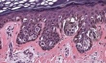 Hallan un nuevo tipo de fármaco contra el melanoma y el cáncer de colon
