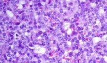 El desarrollo de leucemia linfoblástica aguda está vinculado a la exposición infecciosa