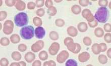 Algoritmos contra la leucemia